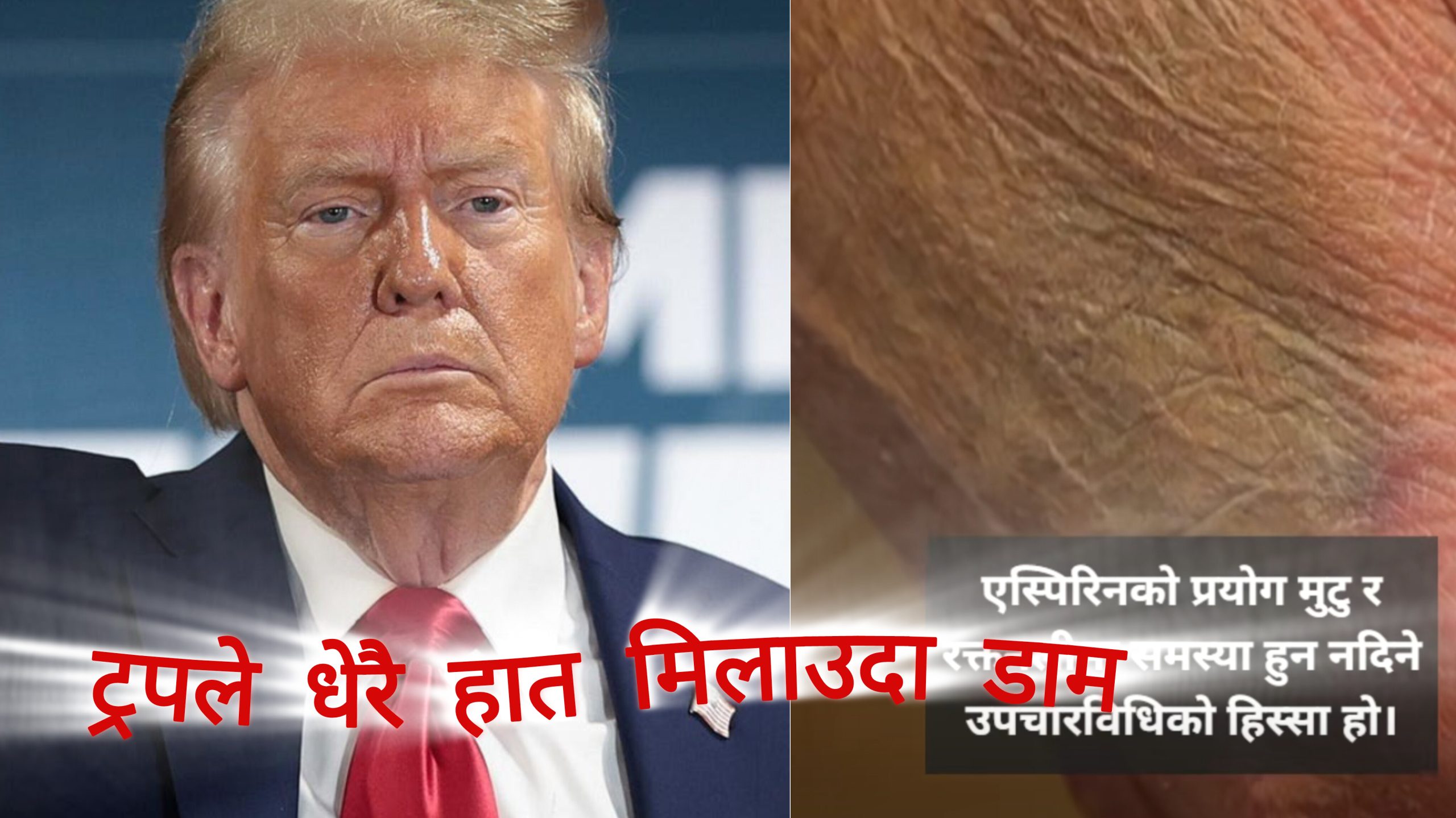 धेरै हात मिलाउदा डोनल्ड ट्रमको हातमा इन्फेक्सन